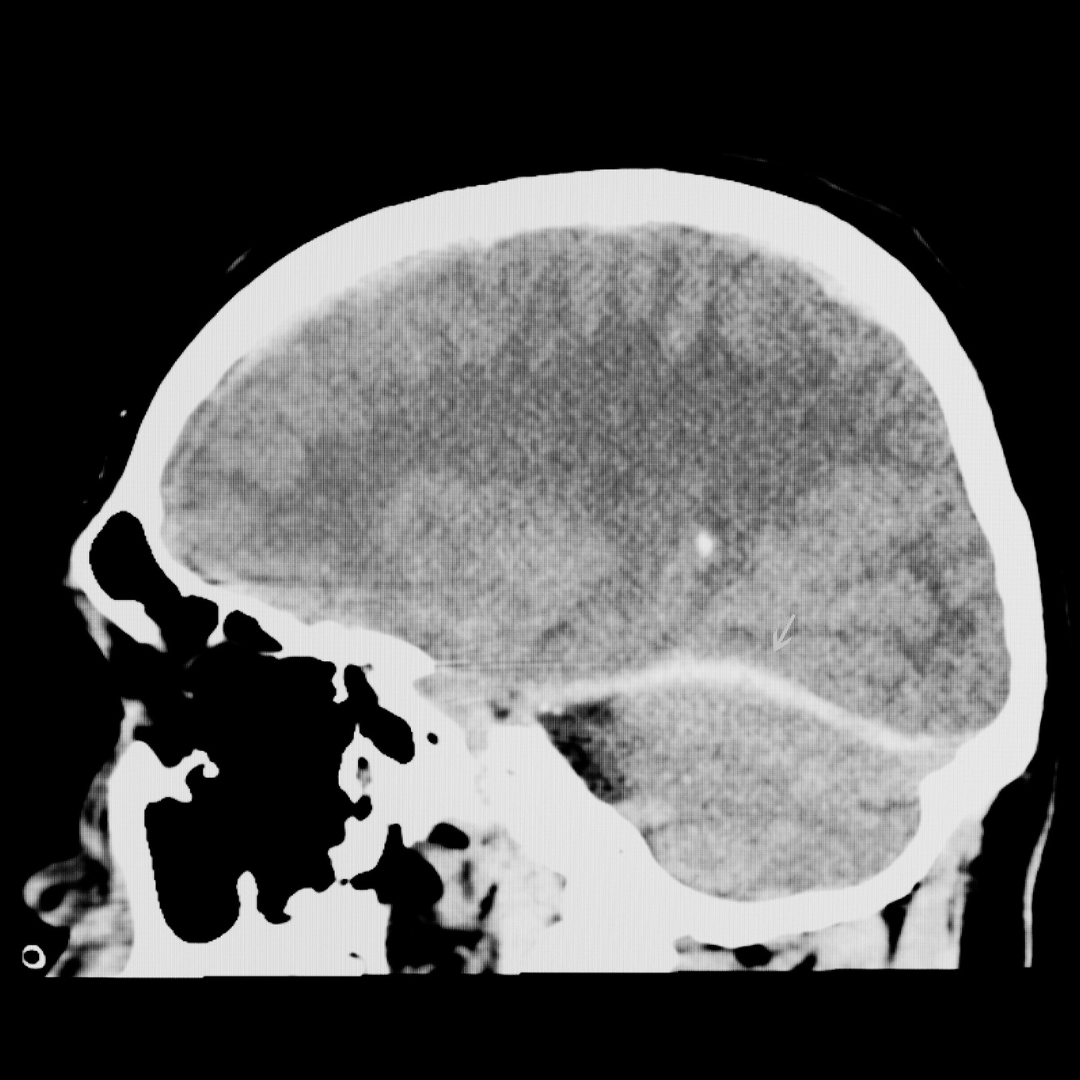 Vision loss after car accident